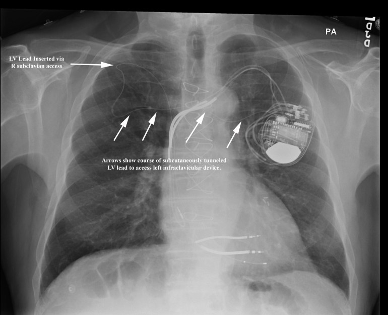 PA CXR of Tunneled LV Lead