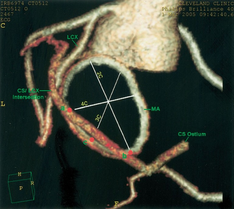 RCA and Circ Relation to CS on CT