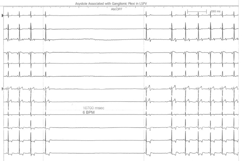 Asystole During Ganglionic Plexi Ablation in LSPV