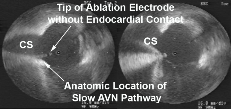 Figure 2  Radial ICE Guidance during AVNRT Ablation of the Slow AV Node Pathway. 