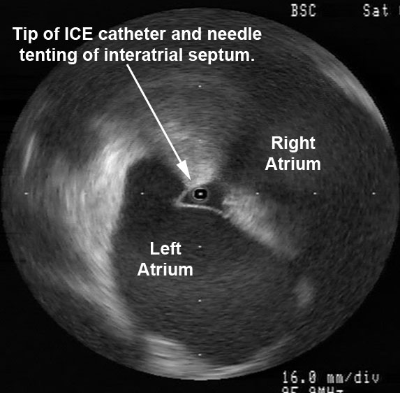  Radial ICE Guidance of Transseptal Puncture for Left Atrial Access