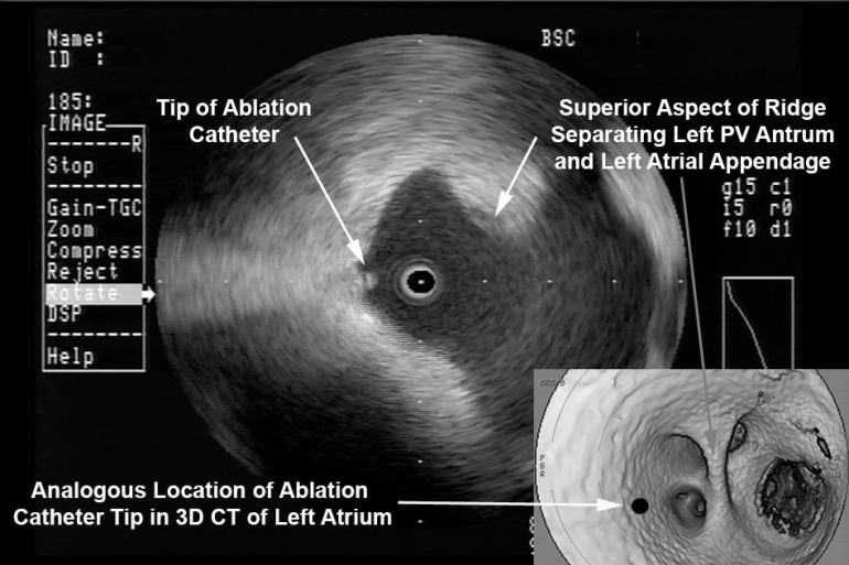 Intra Left Atrial Radial ICE Imaging During Atrial Fibrillation Ablation Left Pulmonary Venous Antrum Isolation