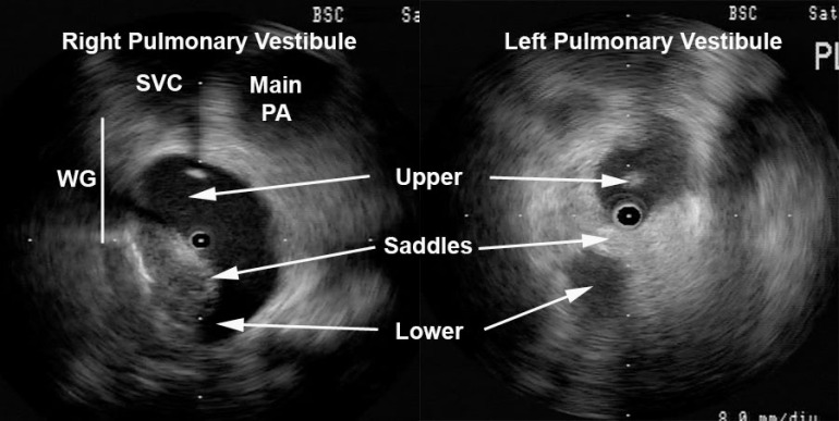 Radial ICE Anatomy of Left and Right Pulmonary Vestibules