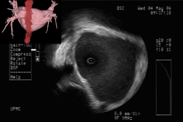 Imaging Demonstrated Proximity of Esophagus to Left Pulmonary Veins. The top left inset of the figure depicts the 3D reconstruction of the left atrium and pulmonary veins with the esophagus tagged in red. The course of the esophagus is along the posterior left atrium in contiguity to the left pulmonary vestibule. The ICE image of the left pulmonary vestibule shows the characteristic echocardiographic signature of an esophageal temperature probe in the 8 o’clock position.